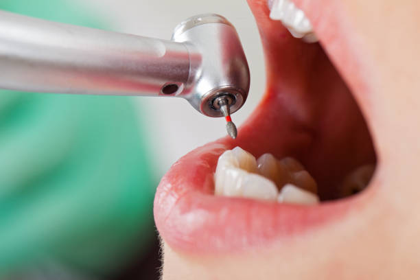Best Emergency Root Canal Therapy in Whiting, WI